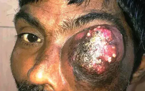 Cancer of the Sinuses